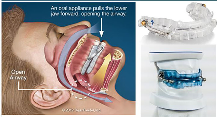 oral-appliances-for-sleep-apnea