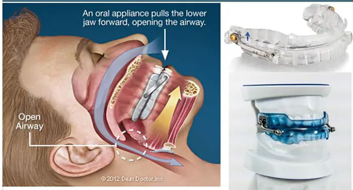 oral-appliances-for-sleep-apnea